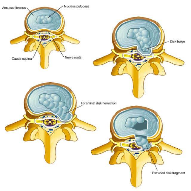 Lumbar disc herniation Radicular pain, sensory deficit, asymmetry of reflexes, or motor