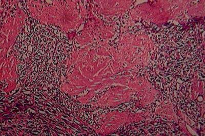 The collagen stained intensely blue with masson s trichrome and immunohistochemistry revealed positivity for smooth muscle actin and vimentin (Figures 6 and 7) but not for desmin, S-100 protein,
