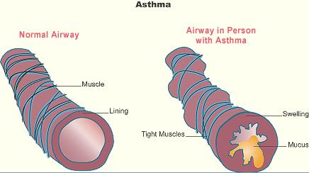 Pathology of Asthma Normal Asthma Asthma involves inflammation of the airways Source: What You and