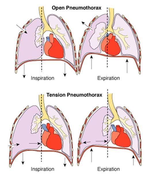 Pulmonary oedema I stage II