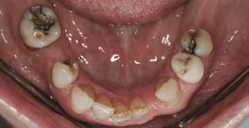 by pain and resulted in extraction. The patient was treated in the practice one year earlier for pain in tooth No. 21 (Figure 4).