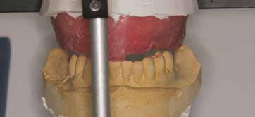 periodontal splint.