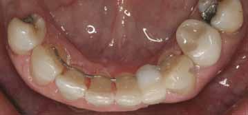Figure 18: The upper denture wax-up mounted in centric relation