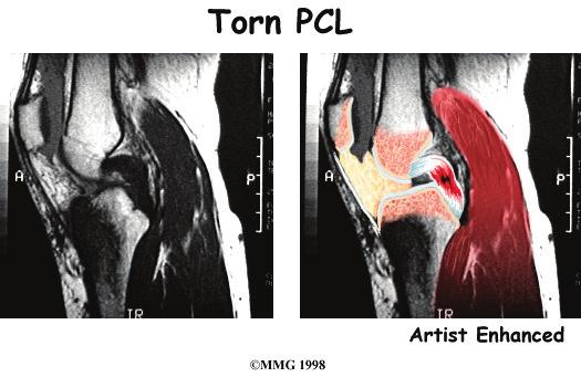 A Patient's Guide to Posterior Cruciate Ligament Injuries Sometimes the PCL is injured during an automobile accident.