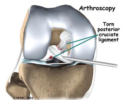 In this situation, the tibia is forced backward under the femur, injuring the PCL. The same problem can happen if a person falls on a bent knee.