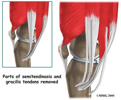A Patient's Guide to Posterior Cruciate Ligament Injuries About one third of the patellar tendon is removed, with a plug of bone at either end. The bone plugs are rounded and smoothed.
