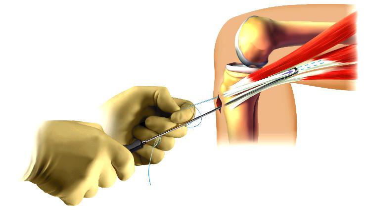 2. ANATOMIC ACL RECONSTRUCTION: The Operation The keyhole surgery operation to reconstruct the ACL involves replacing it with other strong tendons from areas around the knee.