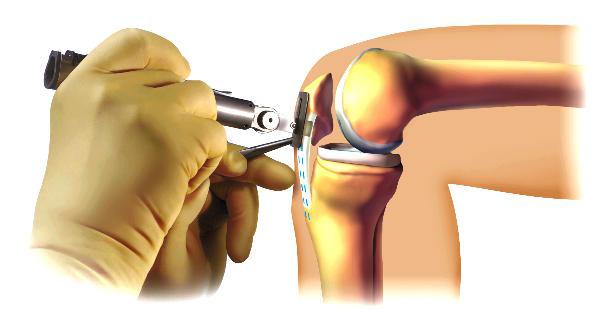 Currently the Hamstring Tendon graft is favoured in most patients and it is probably best to avoid using the patella tendon if there is significant pre-existing pain in the front of the knee, or