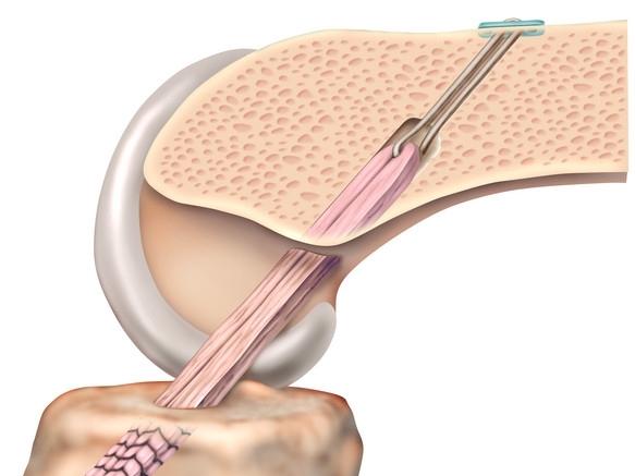The patella tendon graft is made from the central strip of the patella tendon that runs from the knee cap (patella) to the tibia; a small piece of bone is kept attached to the ligament at each end