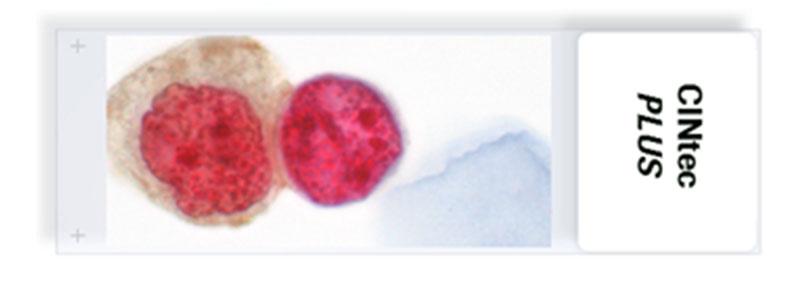 Recommended screening procedure CINtec PLUS Cytology Systematic overlapping fields of view Initially search for isolated dual-stained cells Easiest to evaluate If an isolated dual-stained cell has