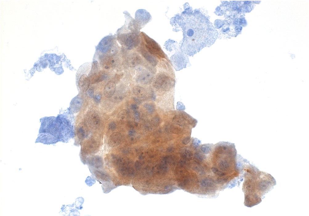 Tissue repair 1. Isolated cell Cluster 2. Dual stained cells at the edge of the cluster 3. p16 staining pattern focal diffuse 4.