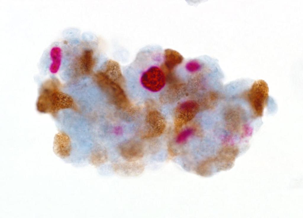 1. Isolated cell Cluster 2. Dual stained cells at the edge of the cluster 3. p16 staining pattern focal diffuse 4.