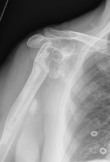 She subsequently developed anterior instability due to sub-scapularis deficiency and was revised to a reverse prosthesis (DELTA, DePuy, UK) one year following primary surgery.