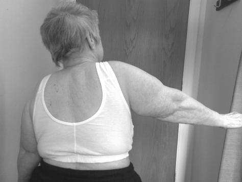 The patient continued to demonstrate signs of instability as well as deficiency of the superior rotator cuff. She therefore underwent excision arthroplasty 8 years following the primary procedure.