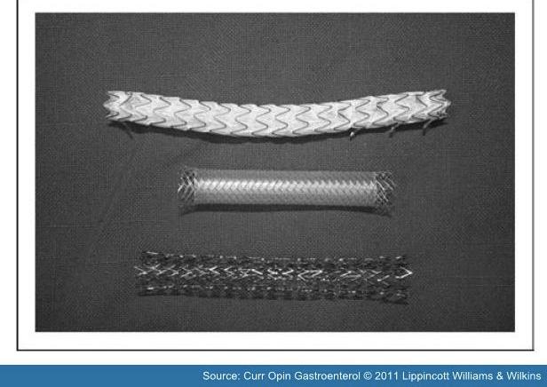 7yr fu Fully covered self expanding metal stent 81% success removal after 4-6mo Cost and skill considerations Gastrointest