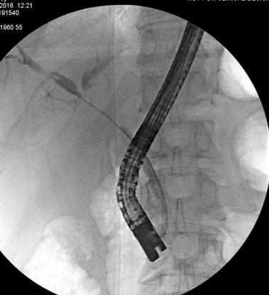 size of balloon/stents needed More expensive, risk of motion artifact Ann Intern Med