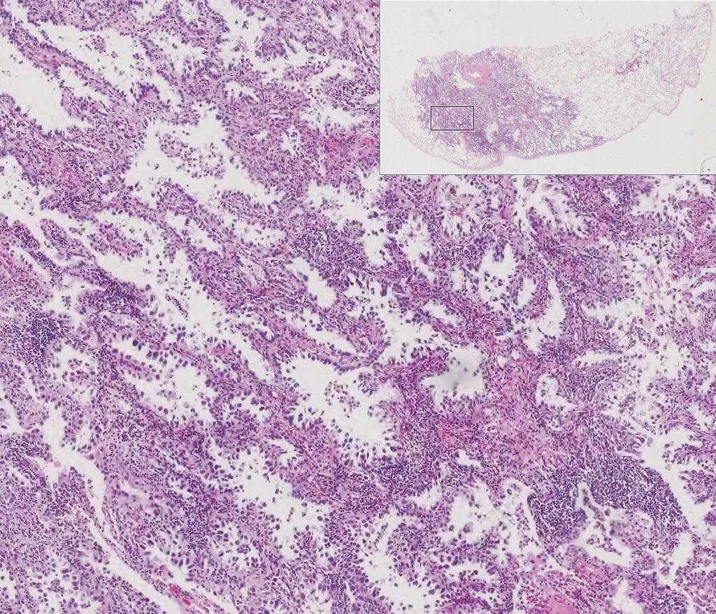 1D) and tumor 2 at the posterior basal segment was 5.1 x 4.9 cm in size and was confirmed to be an invasive mucinous adenocarcinoma (Fig. 1F).