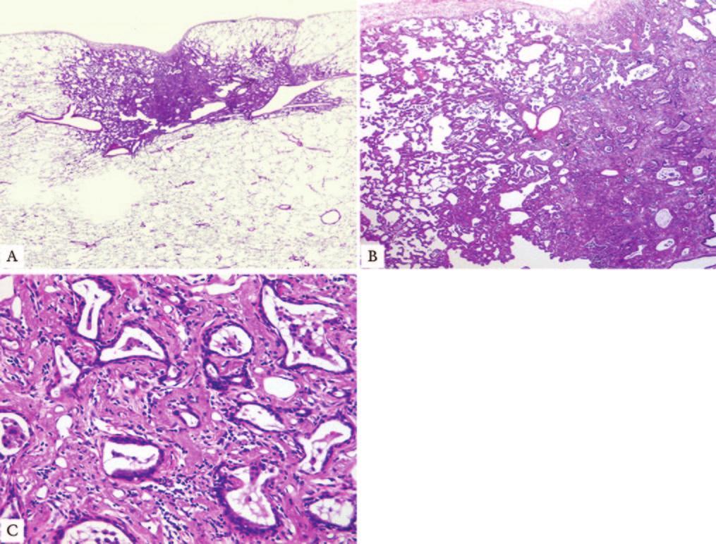 Minimally Invasive Adenocarcinoma (MIA) A small, solitary adenocarcinoma (< 3cm), with a predominantly lepidic