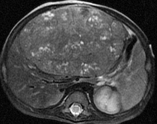Hepatoblastoma: Pretext Additional criteria Cuadate lobe involvement (C1) Extrahepatic abdominal disease Tumor rupture Lymph nodes Distant