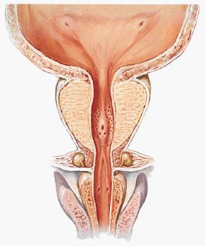 Prostatic Urethra Structures seen on the posterior wall of the prostatic urethra: Urethral crest: A