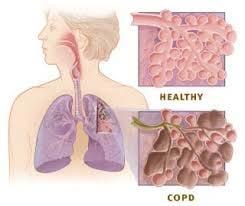 COPD = Chronic