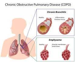 Emphysema Asthma is NOT