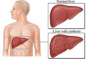 Impact on your health Drinking too much alcohol on a single occasion or over time can cause health problems, including: Liver