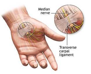 movements Can compress tendons and