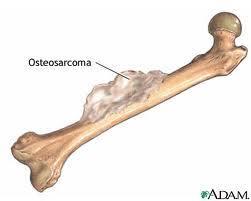 Bone Tumors Bone Tumors Most are