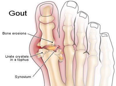 Gout Uric acid crystals cause inflammation Joint is extremely painful, swollen