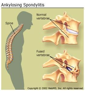 spaces Leads to a rigid spine Poker back S/S; Low back pain radiating to legs,