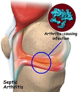 Infectious (Septic) Arthritis Bacterial