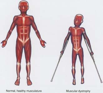 Muscular Dystrophy Inherited skeletal muscle disease Muscles atrophy, deteriorate & get progressively weak Sons Inherit