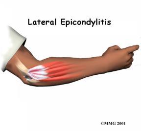 Epicondylitis Tendonitis Inflammation of tendons Common