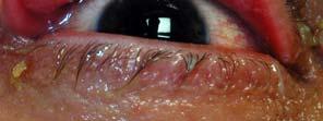Syndrome Disorders of Lacrimal