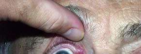 Any abnormality in the lacrimal system can