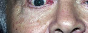 infection Lacrimal Stent Canaliculitis