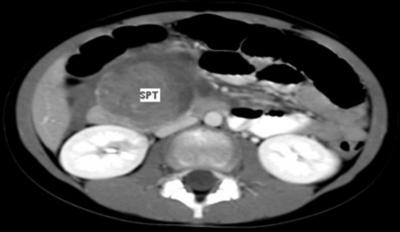 Figure 2 Figure 4 Figure 1: Contrast CT abdomen showing SPT as a heterogenously dense mass arising from the head of pancreas Figure 3: Gross picture of SPT of pancreas showing encapsulation with