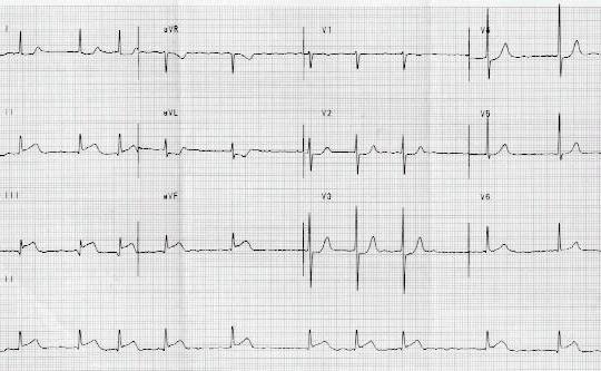 ST Elevation Infarction ECG of an inferior MI: Look at the inferior leads (II, III, avf) What ECG changes do you see?