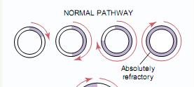 When the pathway isn t long enough, the head of the reentrant impulse bites its own refractory tail, resulting in