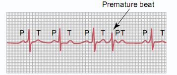 AV Premature Contractions Premature contractions fired from the A-V node or the A-V bundle The P wave is superimposed