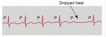 2nd Degree AV Block, Mobitz Type II Deviation from NSR Occasional P waves are completely blocked (P wave not followed by QRS), usually