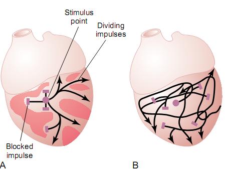 Ventricular Fibrillation Deviation from NSR Completely abnormal, with ultrarapid baseline undulations, irregular in timing and