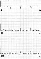 way to estimate if the QT interval is long is to use the