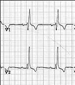 Right Bundle Branch Block What QRS morphology is characteristic?