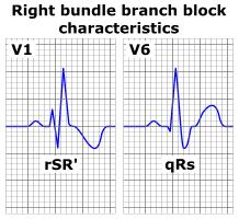 The terminal vector of ventricular depolarization, corresponding to delayed RV depolarization, is oriented anteriorly and to the right: rsr in V1 and