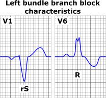 Left Bundle Branch Block Both early and later phases of ventricular depolarization are altered: both septal and left wall depolarization vectors are oriented posteriorly and to the left wide