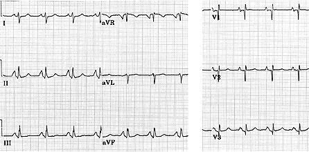 Right atrial enlargement P wave morphology: sharp, tall, symmetric in V1, V2, avf, II, III; if biphasic in V1, the positive initial deflection predominates P wave axis: + 75