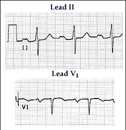 Left atrial enlargement The P waves are broad (> 0.12 s) and often notched in lead I, avl, V5, V6 ; in lead V1 they have a deep and wide negative component In lead II, > 0.