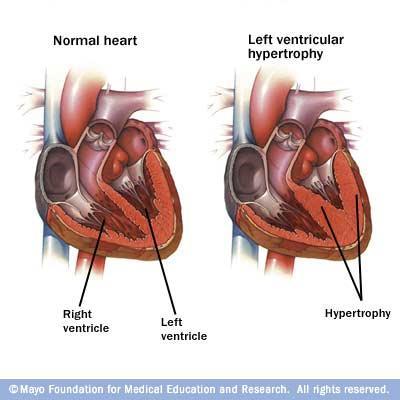 Left Ventricular Hypertrophy Why is left